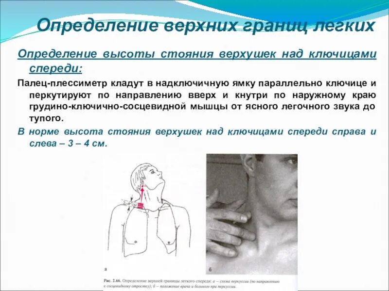 Верхушки легких в норме. Топографическая перкуссия легких верхняя граница.