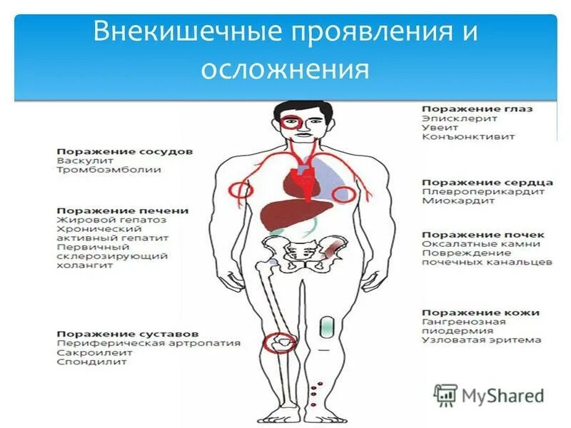 Внекишечные проявления бк як. Внекишечные проявления болезни крона таблица. Внекишечные осложнения болезни крона. Внекишечные проявления заболеваний кишечника. Внекишечные осложнения болезни крона.