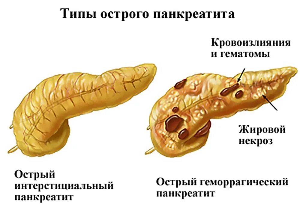 Поджелудочная железа при остром панкреатите. Типы острого панкреатита. Поджелудочная железа панкреатит типы. Хронический панкреатит поджелудочная железа.