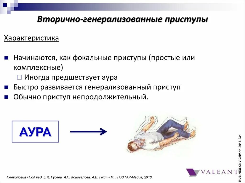 Первично генерализованные припадки. Вторично генерализованные приступы. Генерализованная эпилепсия. Вторично генерализованные эпилептические припадки.