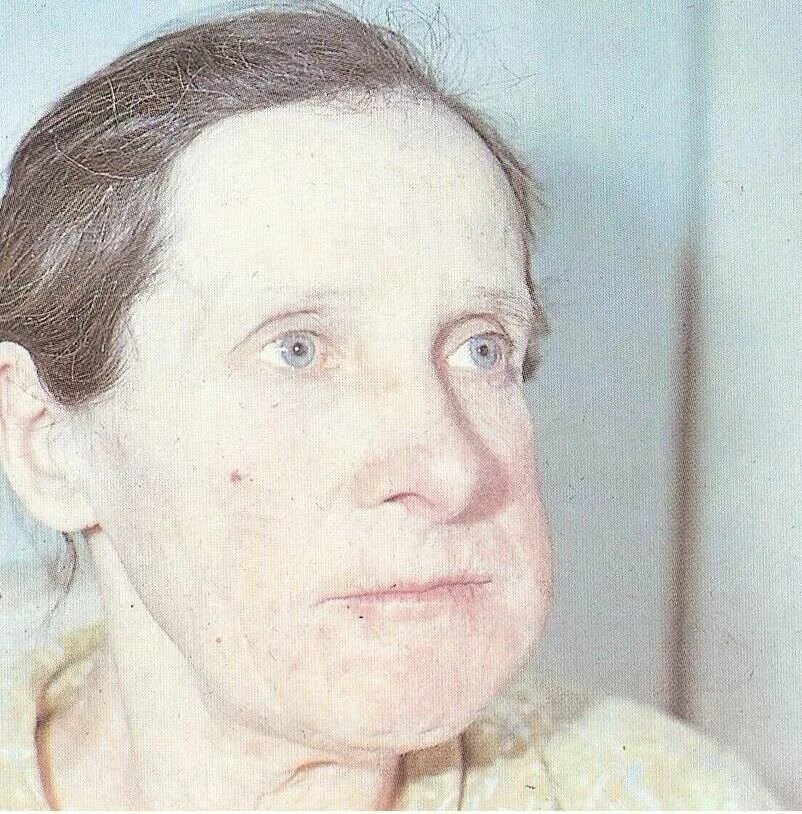 Радивая челюсть фото. Эван байерс. Макрогнатия и микрогнатия. Радиевые девушки грейс фрайер. Дистальный прикус (птичий профиль).