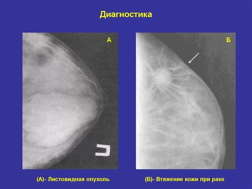 Опухоли молочных желез. Втяжение кожи на молочной железе. Ямка на молочной железе. Новообразование на груди. Онкология молочных желез симптомы