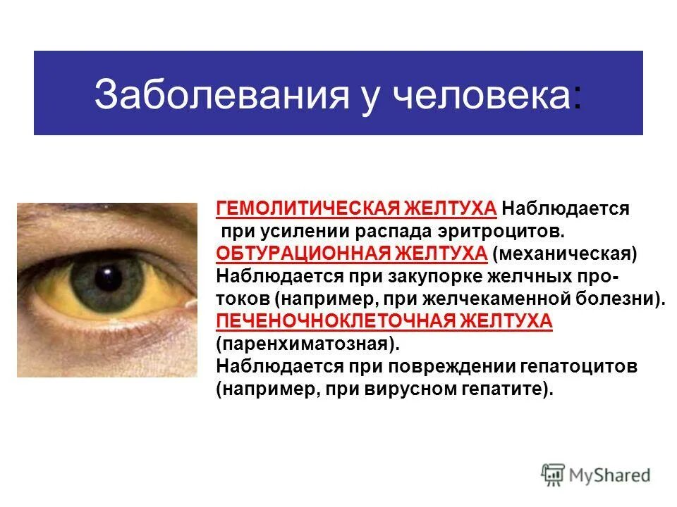 желтуха у взрослых детей. желтуха при каких заболеваниях. желтуха при каких заболеваниях. клинические проявления желтухи. гемолитическая желтуха болезнь боткина.