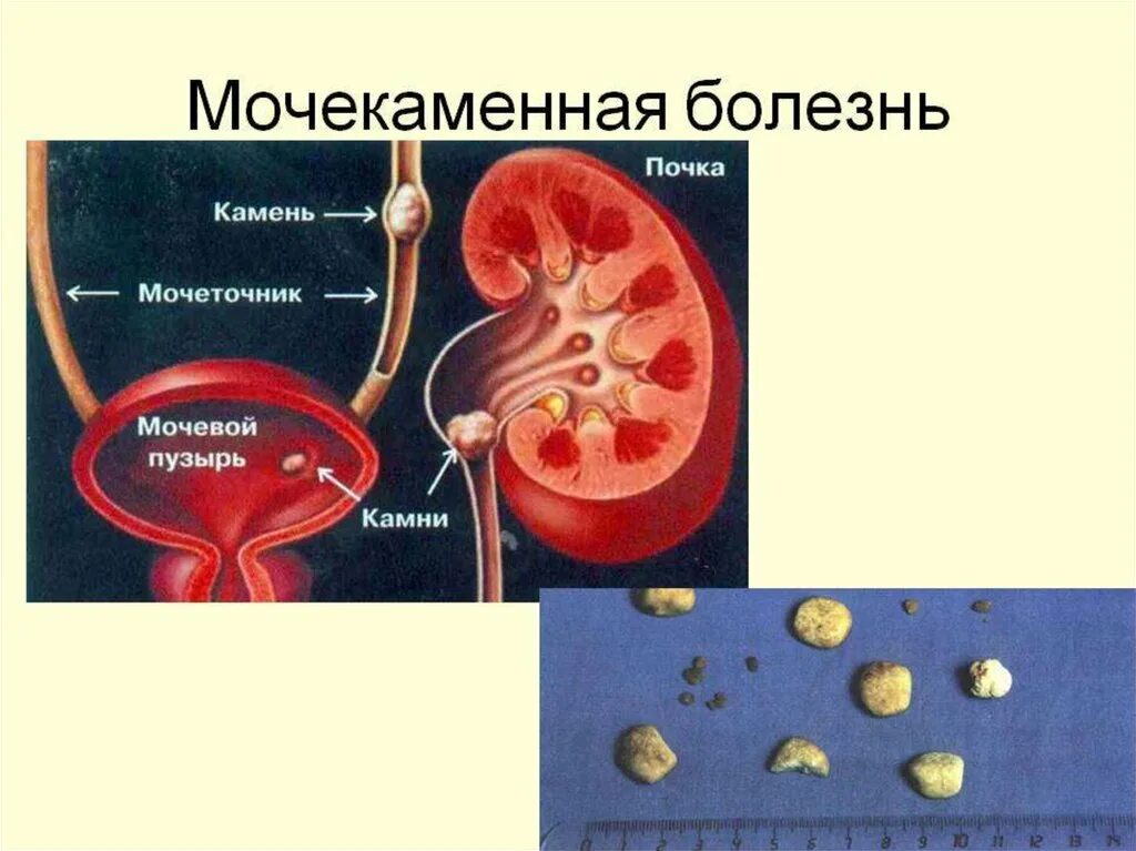 Заболевания почек мочекаменная болезнь