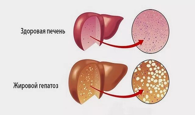 Острая жировая печень. Жировая дистрофия печени. Жировой гепатоз печени.