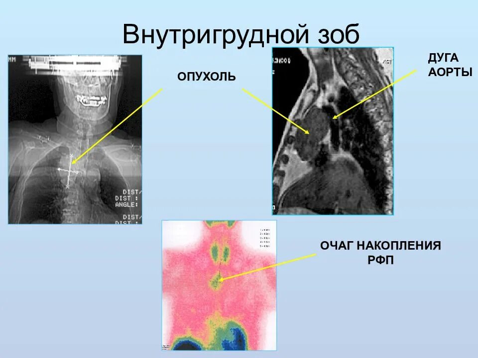 Загрудинный зоб щитовидной железы рентген. Внутригрудной и загрудинный зоб. Пищевод зоб