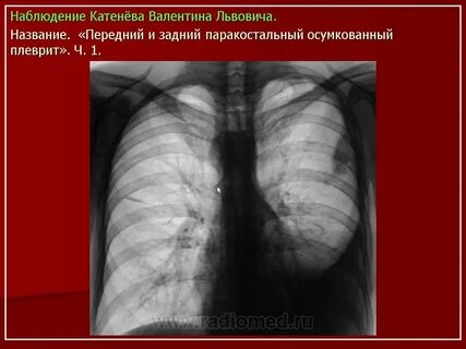 Осумкованный плеврит