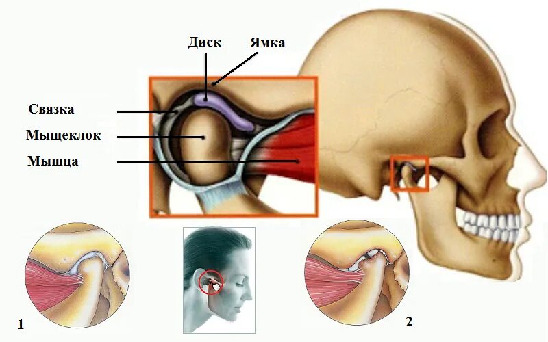 Суставная головка ВНЧС. Суставной диск ВНЧС мрт.