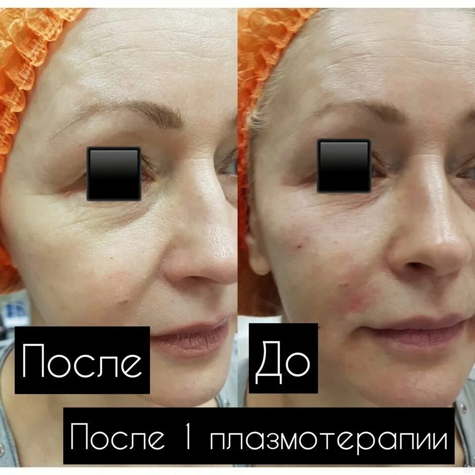 Плазмолифтинг отзывы фото до и после лицо. Плазмолифтинг лица сразу после. Плазма в косметологии для лица.