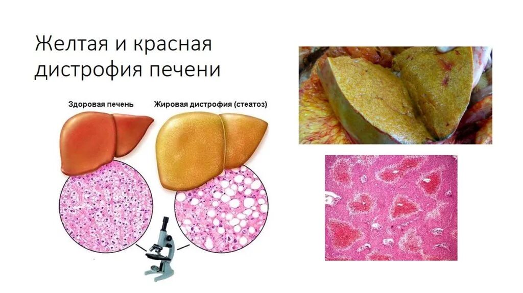 Дистрофия печени причины. Токсическая дистрофия печени морфология. Токсическая дистрофия печени макропрепарат. Токсическая дистрофия печени КРС. Токсическая дистрофия печени у животных.