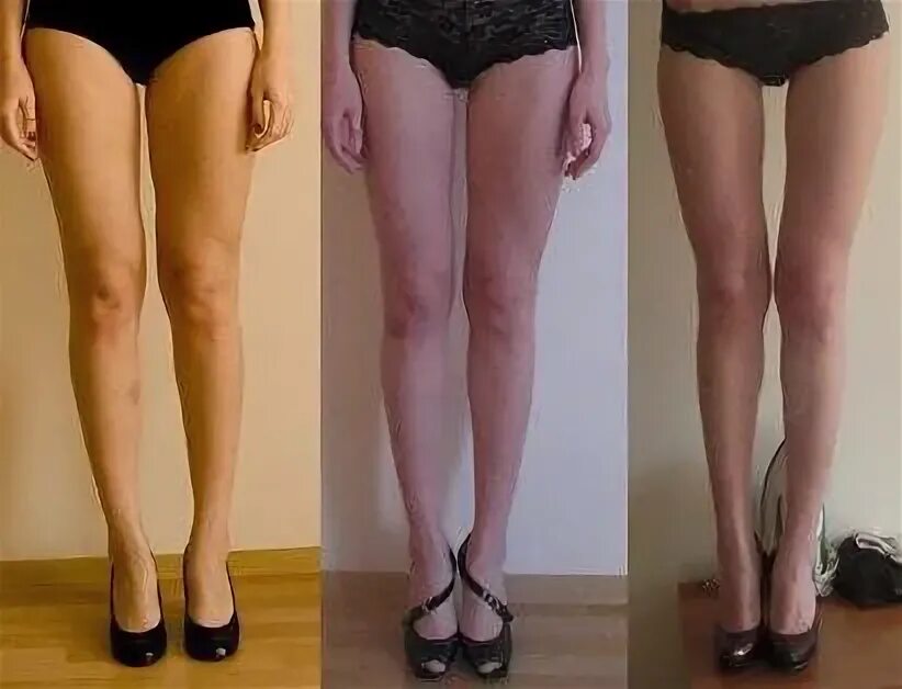 Ноги женщин выше колен. Тонкие икры ног. Худые ноги. Ровные ноги.