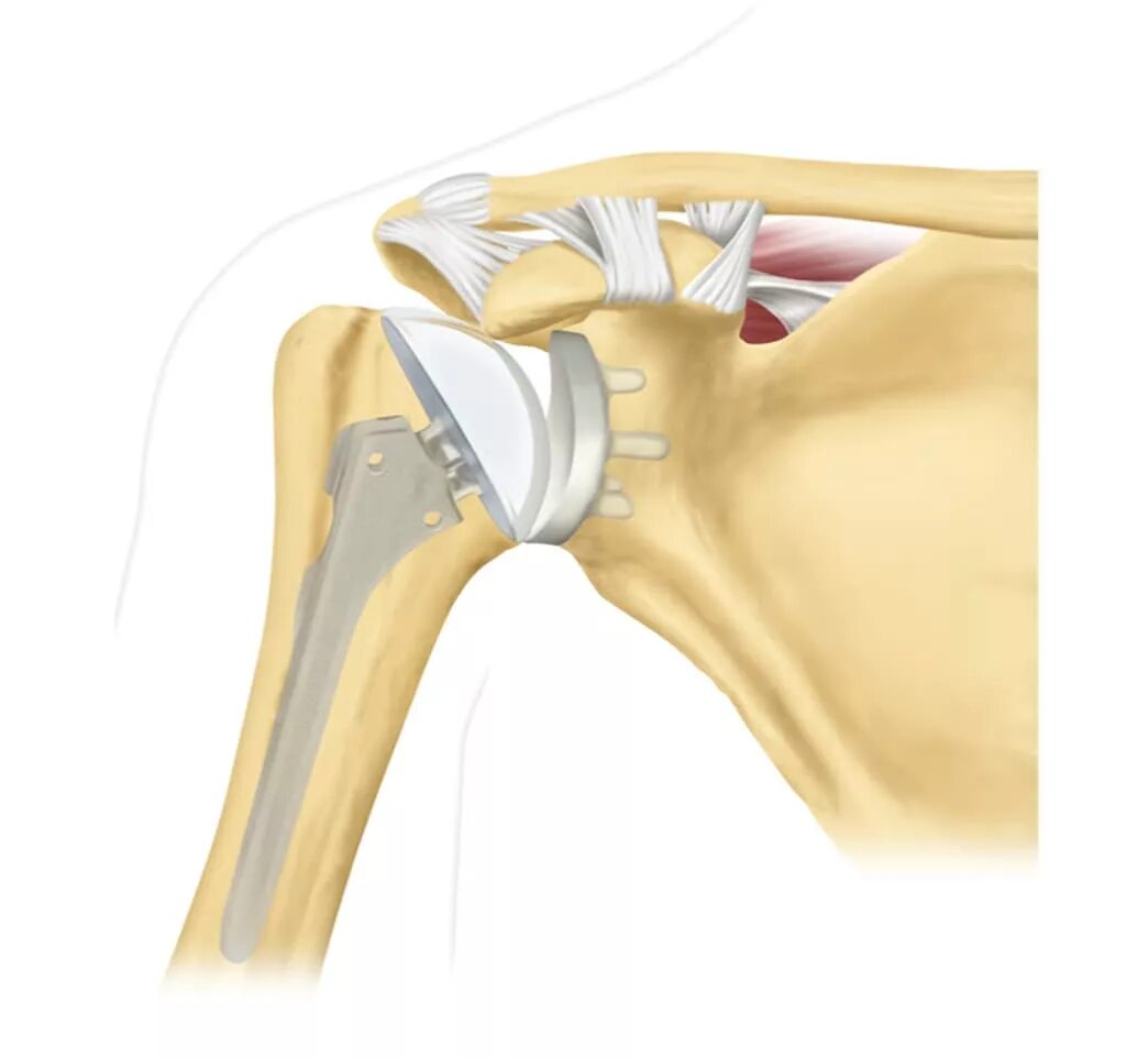 Эндопротез плечевого сустава Тотальный реверсивный. Остеоартроз плечевого ключичного сустава. Однополюсное эндопротезирование плечевого сустава. Остеоартроз плечевого сустава 1. Операция по замене плечевого сустава