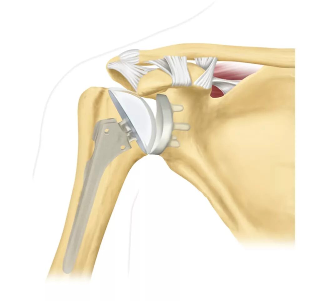 Операция по замене плечевого сустава. Эндопротез плечевого сустава Тотальный реверсивный. Остеоартроз плечевого ключичного сустава. Однополюсное эндопротезирование плечевого сустава. Остеоартроз плечевого сустава 1.