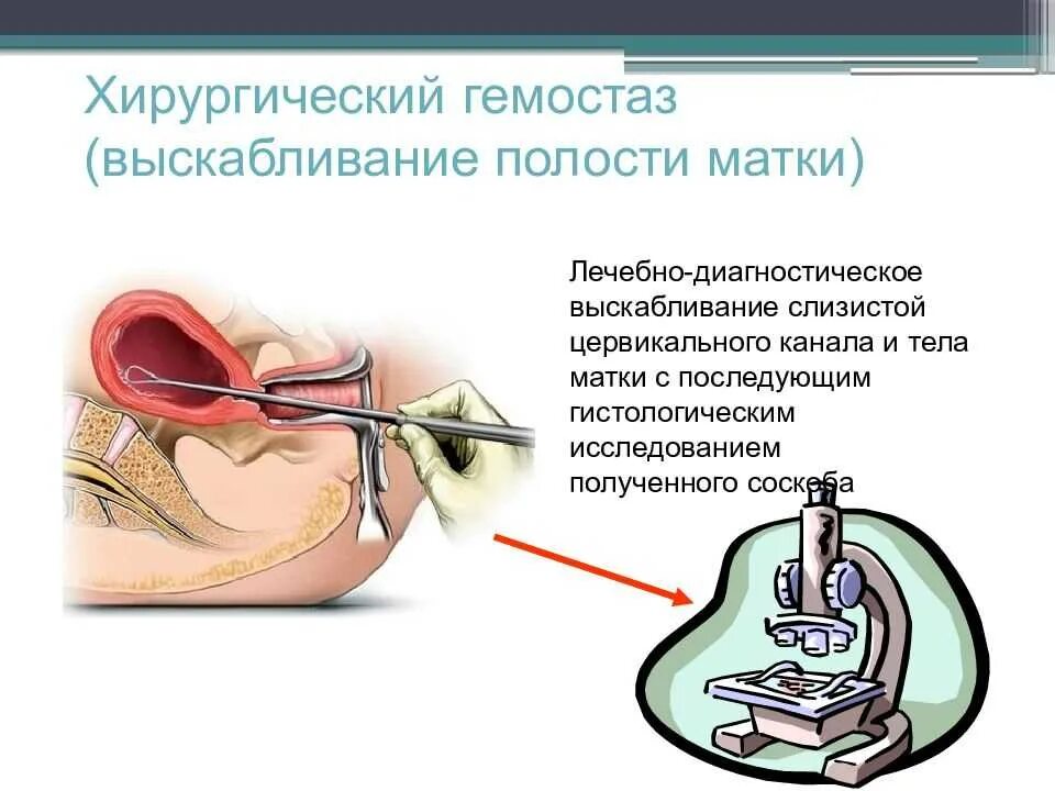 Диагностическое выскабливание полости матки