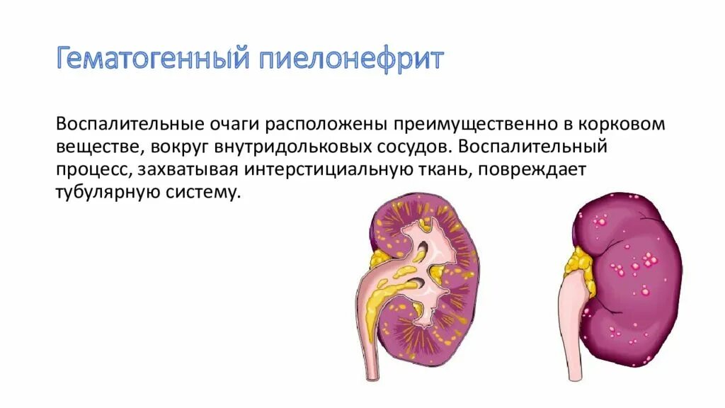 Хронический пиелонефрит гистология. Гематогенный пиелонефрит. Пиелонефрит характеризуется воспалением. Пути проникновения инфекции в почку при пиелонефрите.