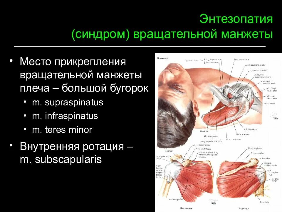 Травматический плексит. Степени импинджмент синдрома плечевого сустава. Синдром манжета. Субакромиальный импиджмент синдром правого плечевого сустава. Синдром манжета.