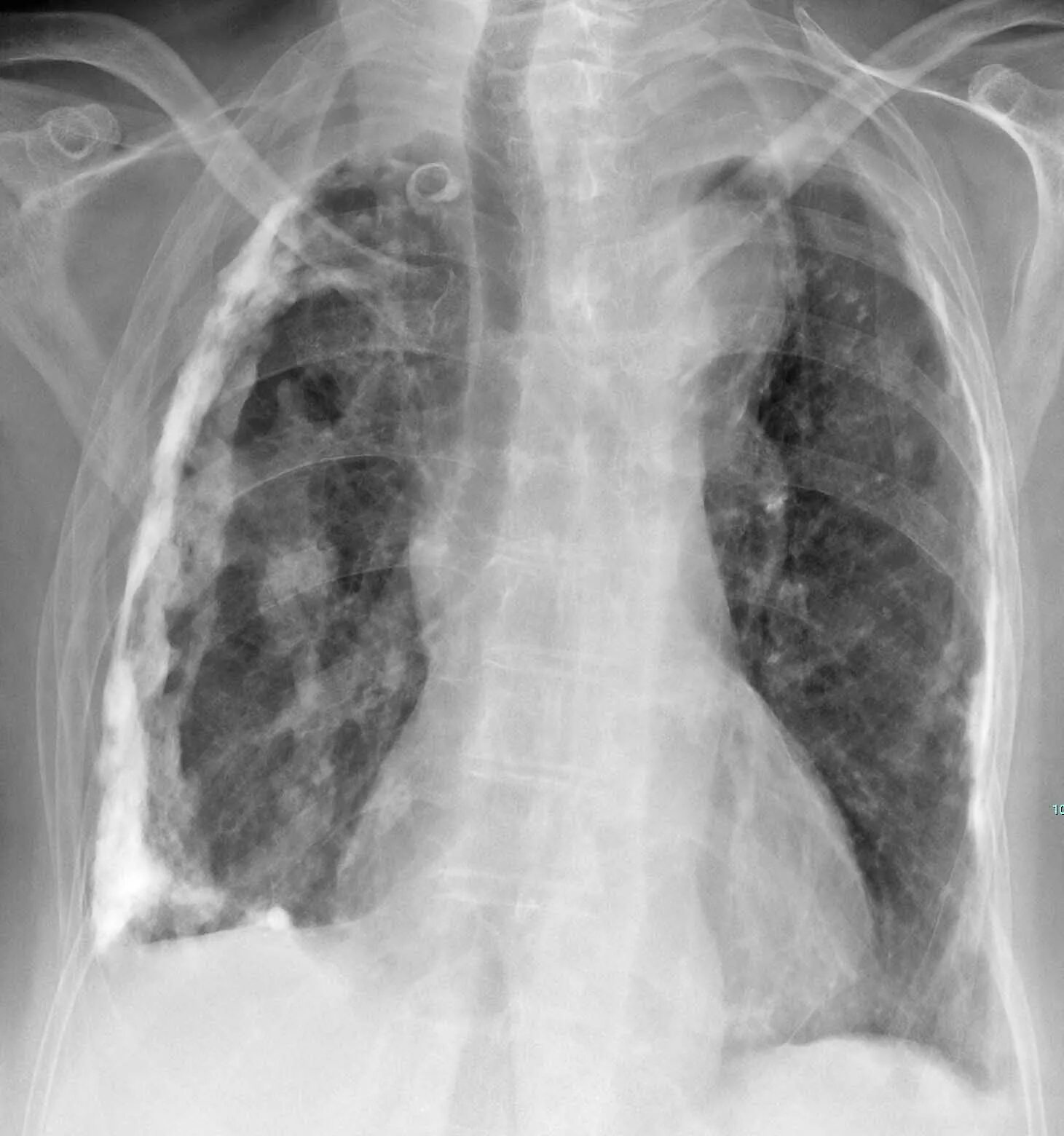 синусы плевры анатомия. медиастинальная плевра диафрагмальная плевра. медиастинальная плевра кт. осумкованный плеврит легких рентген. диафрагмальный плеврит рентген.