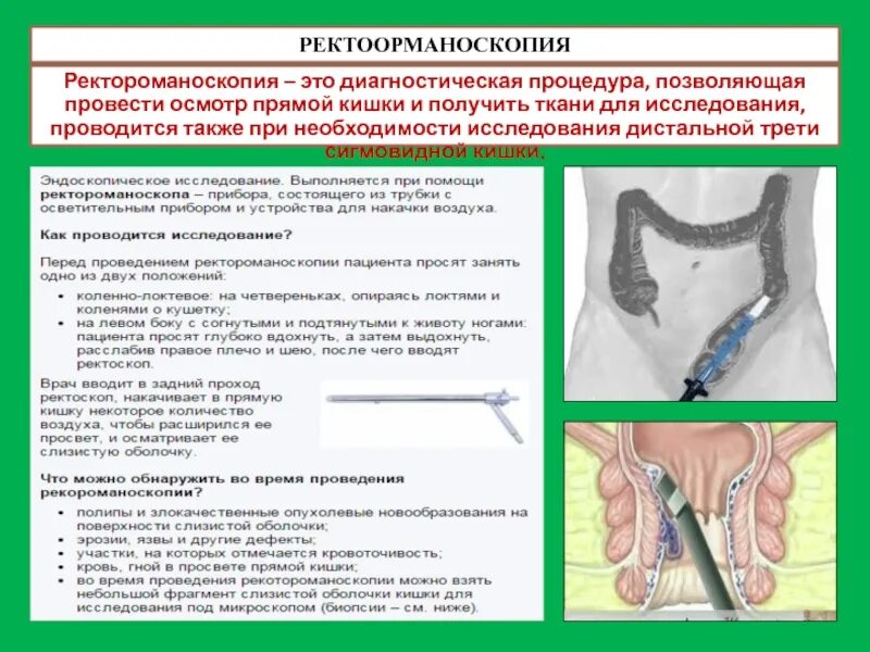 Исследование прямой кишки ректоскопия. Методика выполнения ректороманоскопии. Исследование прямой кишки ректороманоскопия. Ректороманоскопия это эндоскопическое исследование. На какую глубину вводят ректальную свечу