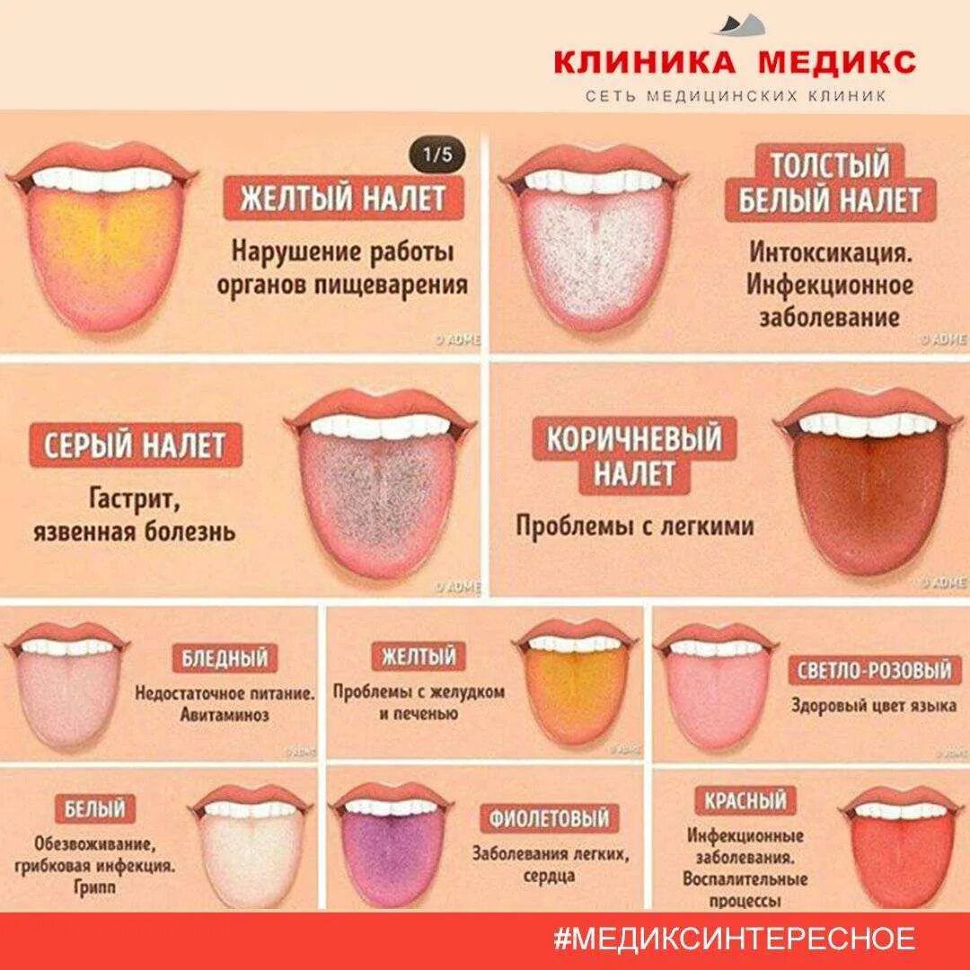 Как избавиться от вкуса во рту. Заболевания по цвету языка.