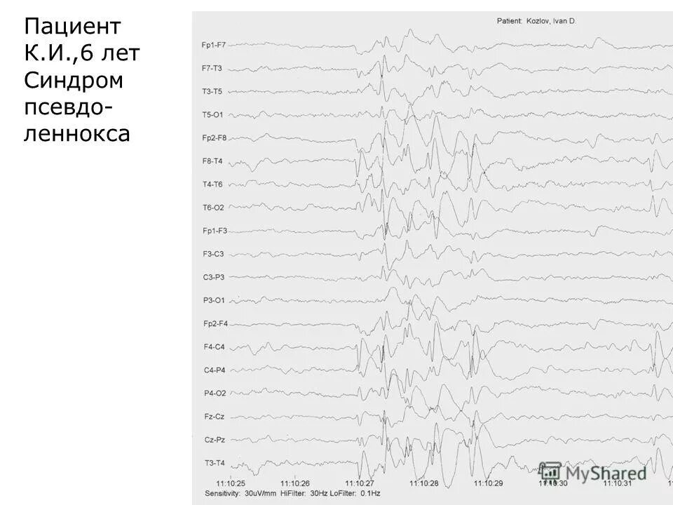Псевдо синдром. Синдром Леннокса-Гасто ЭЭГ. Синдром псевдо Леннокса. Синдром Леннокса Гасто признаки на ЭЭГ. Леннокса Гасто эпилепсия.