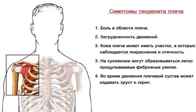 Сильно болит левое плечо. Болит в левом плече спереди. Болит плечо спереди. Болит спереди плеч. Болит левое плечо.