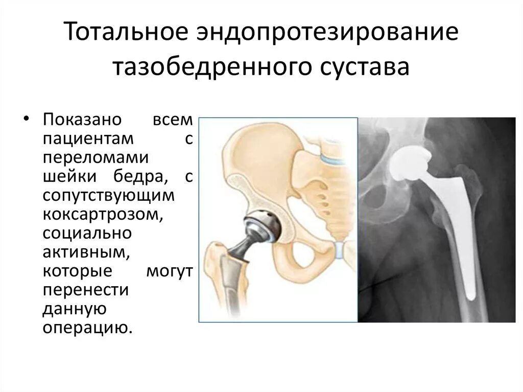 Тотальный бесцементный эндопротез тазобедренного сустава. Операция эндопротезирование шейки бедра. Эндопротезирование тотальными протезами тазобедренного сустава. Перелом шейки бедра операция эндопротез. Тазобедренный сустав после операции отзывы пациентов