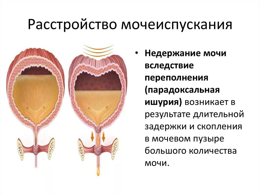 Резкое частое мочеиспускание. Нарушение мочеиспускания. Причины нарушения мочеиспускания. Типы нарушения мочеиспускания. Процесс женского мочеиспускания.