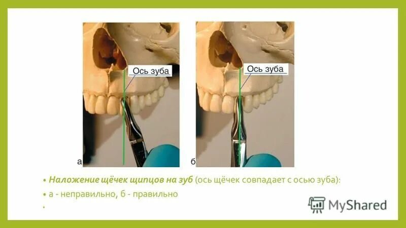 Местные осложнения операции удаления зуба. Ось зуба.