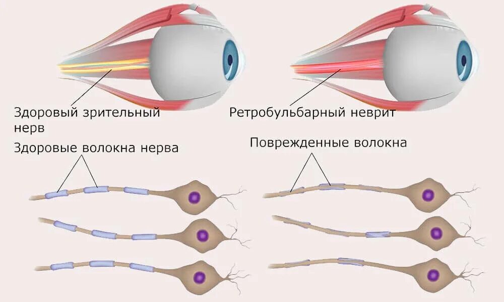 Ретробульбарный неврит симптомы. Ретробульбарный неврит зрительного. ретробульбарный неврит зрительного нерва клиника. патогенез ретробульбарного неврита зрительного нерва. неврит зрительного нерва этиология.