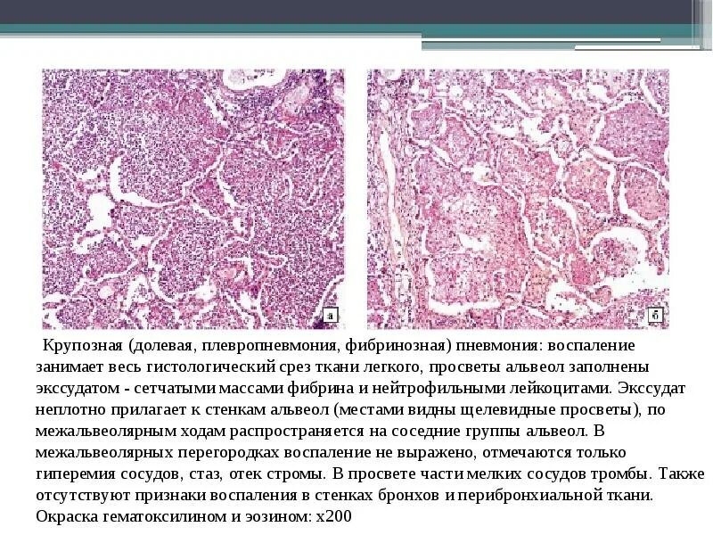 Крупозная пневмония экссудат. Абсцедирующая пневмония гистология. Макрофагальная пневмония гистология. Фибринозный перикардит гистология.