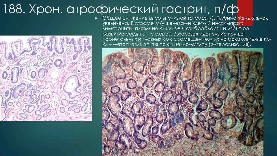 Патан пф. Фибринозный гастрит патологическая анатомия. толстокишечная метаплазия гистология. патанатомия хронический атрофический гастрит микропрепараты.