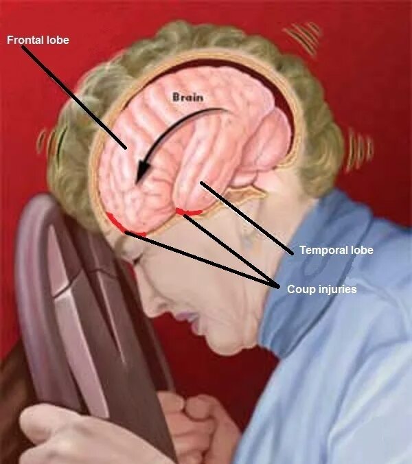 Открытое сотрясение мозга. Шум в голове в мозге