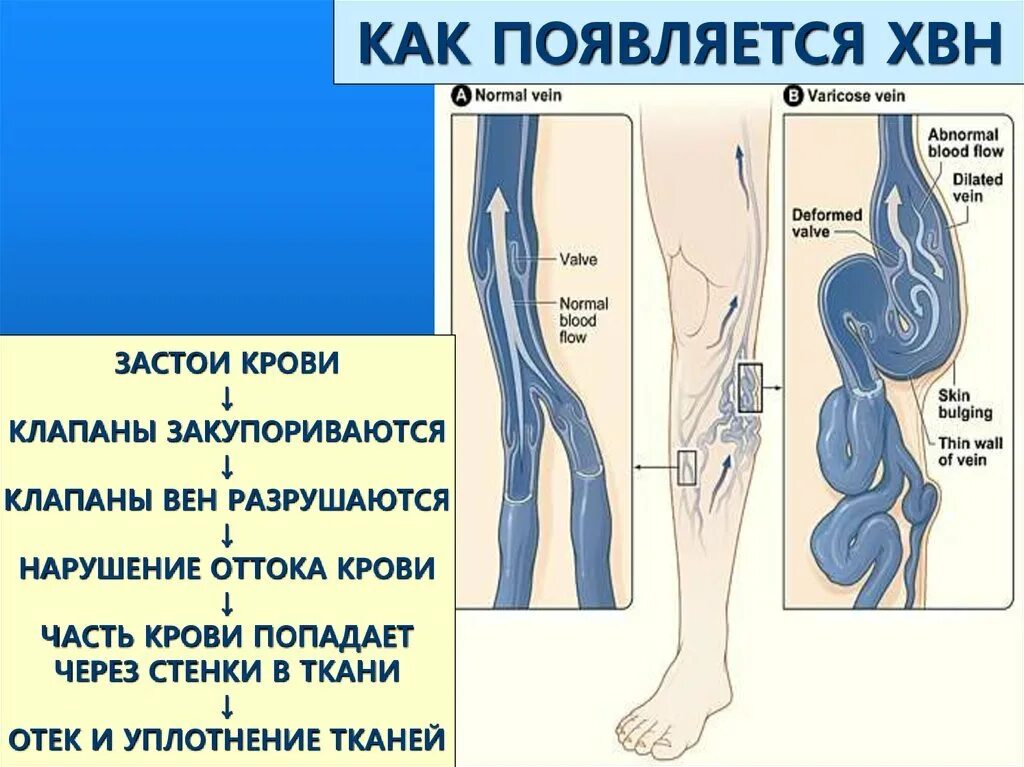 Схема развития хронической венозной недостаточности. Венозная недостаточность, варикозное расширение вен. Варикозное расширение вен нижних конечностей ХВН. Хроническая венозная недостаточность симптомы. Тромбоз вен таза