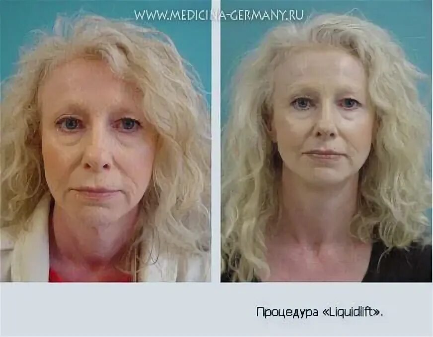 Можно ли пить ботокс