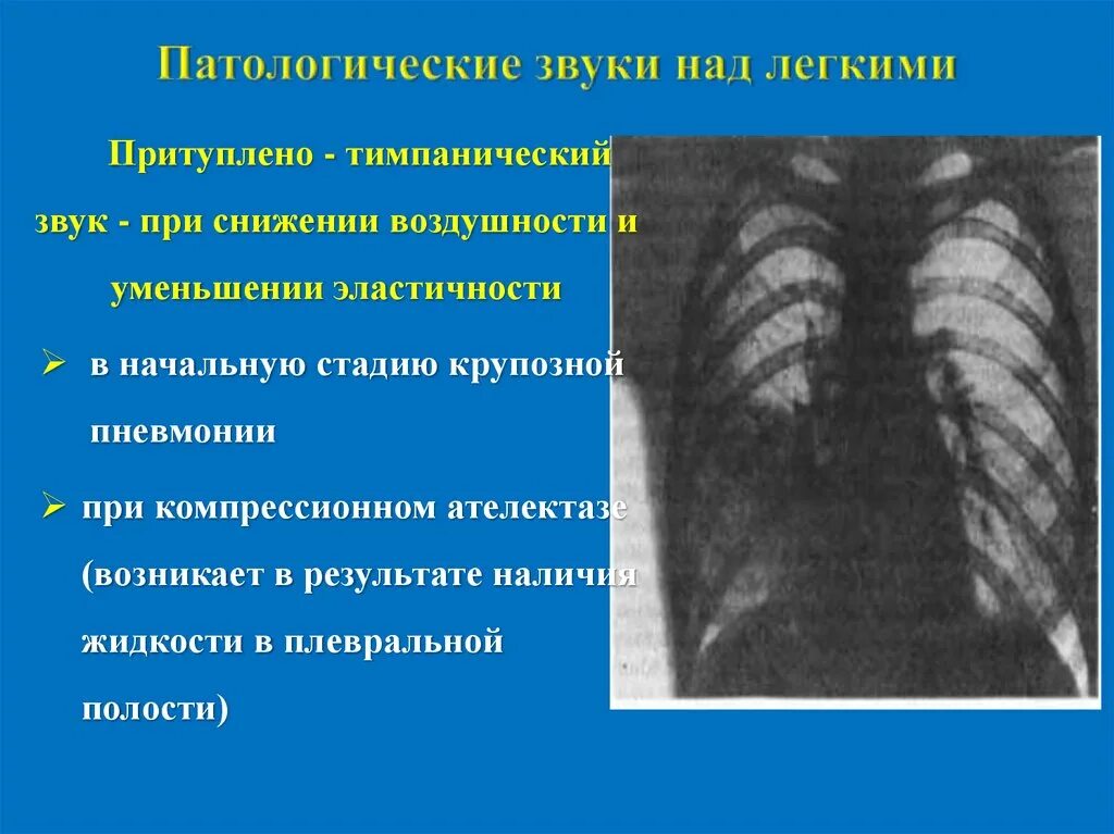 Легочный звук при пневмонии. Пневмония звуки в легких. Звук при пневмонии. Звуки в лёгких при пневмонии. Звук в легких при дыхании