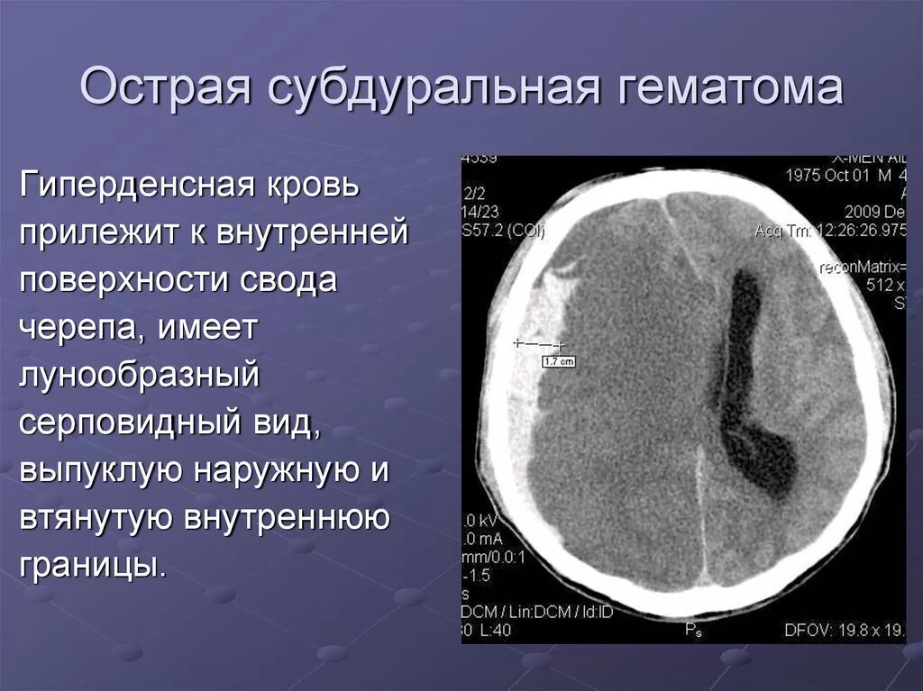 Кт острой субдуральной гематомы. Острая субдуральная гематома кт. Кт при отеке головного мозга. Признаки отека мозга при кт головного. Гематома в стадии организации