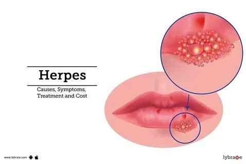 Herpes Causes Symptoms Treatment and Cost 