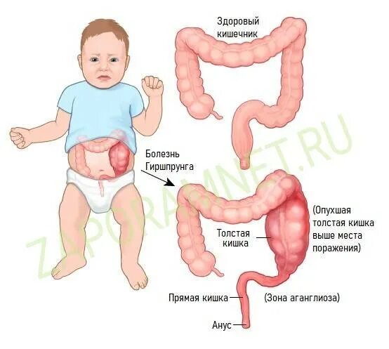 Удлиненный кишечник. Аномалия развития Толстого кишечника долихосигма. Сигмовидная кишка долихосигма. Мегаколон болезнь Гиршпрунга. Симптомы долисогмы у ребенка.