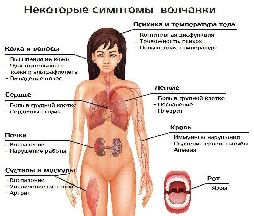 Признаки волчанки у женщин симптомы