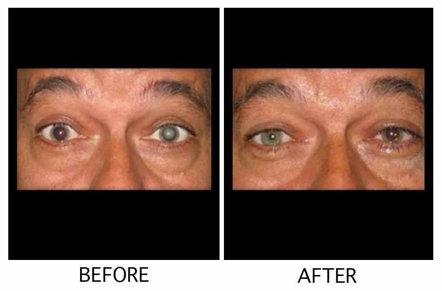 Катаракта глаза операция. Катаракта до и после операции. Когда можно мыть голову после катаракты