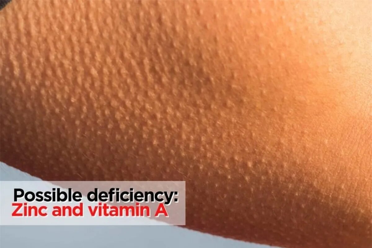 дефицит витамина а сухая кожа. витаминос. заболевания при дефиците витаминов. недостаток витамина а симптомы. симпеталы аветоминоза.