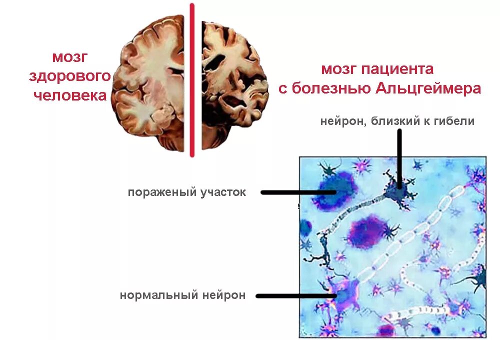 Пациенты с поражением мозга. Болезнь Альцгеймера патанатомия. Холинергическая теория болезни Альцгеймера. Болезнь Альцгеймера патологическая анатомия. Морфологические изменения головного мозга при Альцгеймера.