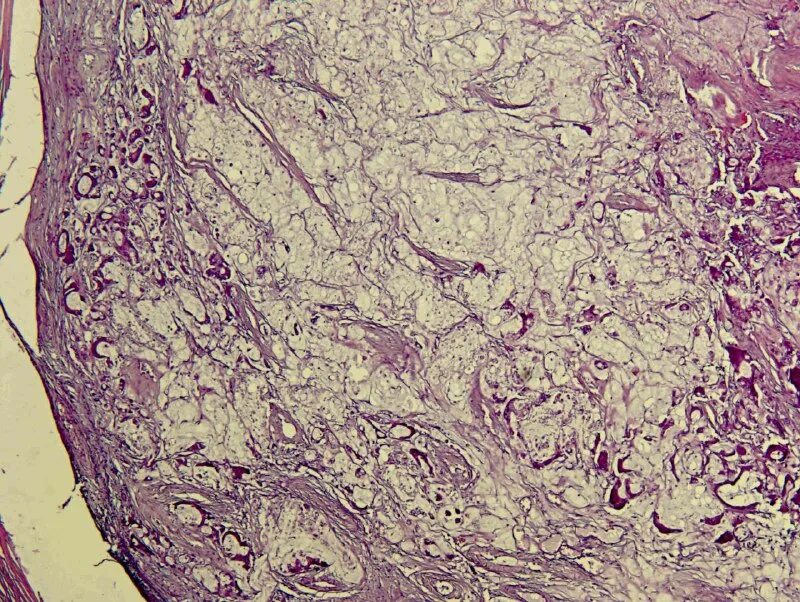 аденокарцинома молочной железы гистология. муцинозная аденокарцинома толстого кишечника. муцинозная карцинома толстой кишки. мультифокальная аденокарцинома. аденокарцинома кожи фото.