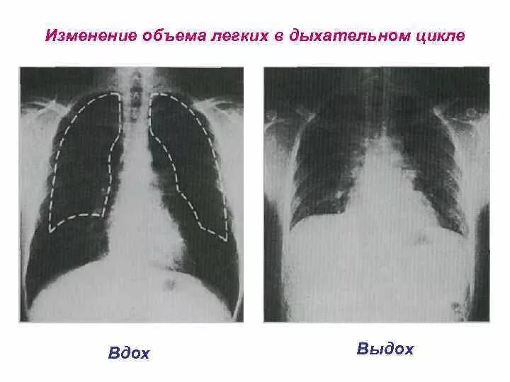 Изменение объема легких. Снимок легких на выдохе. рентгенография на выдохе. снимок легких на вдохе и выдохе.