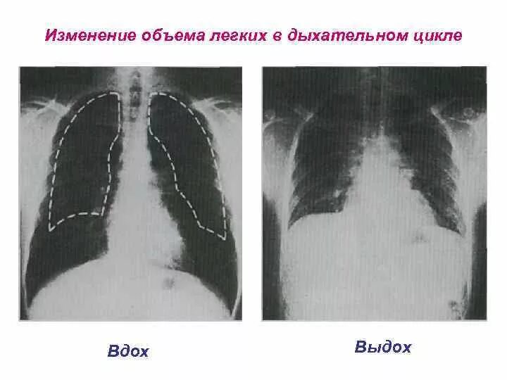 Изменения объема легких. Изменение объёма легких. Снимок легких на вдохе и выдохе. Рентген легких на выдохе. Рентген легких на вдохе и выдохе.