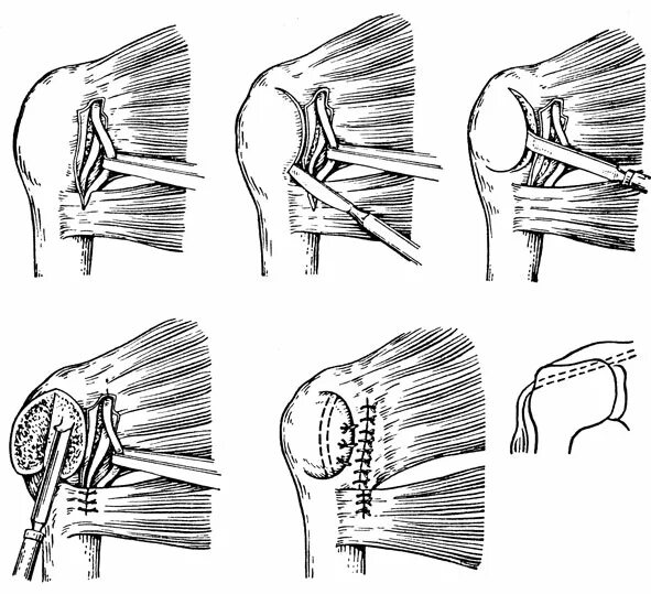 Комбинированные операции. Операция при вывихе плечевого сустава. Операция бристоу латарже. Операция розенштейна плечевого сустава. Операция при привычном вывихе плеча.