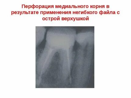 Перфорация канала зуба
