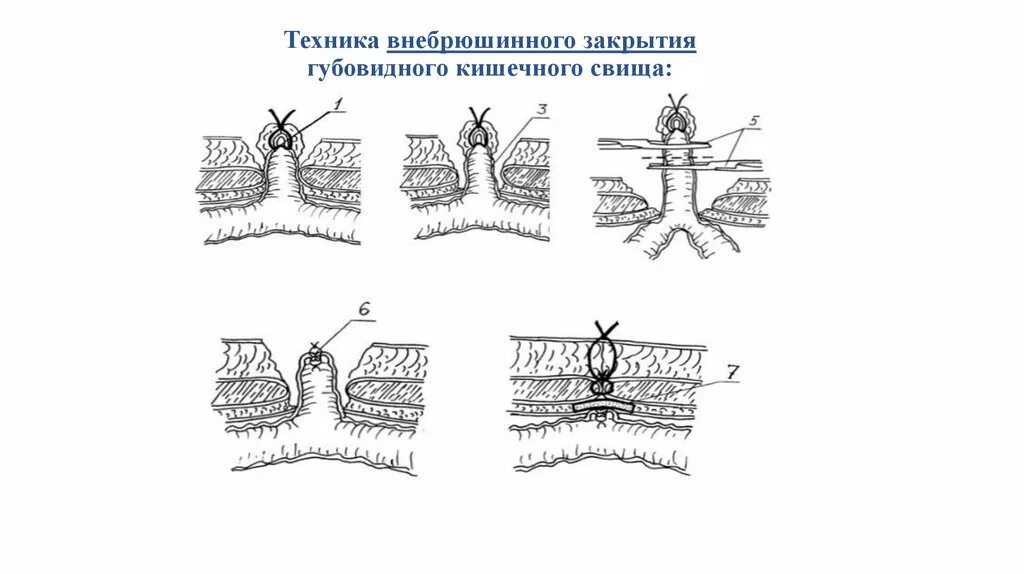 Международный день по искоренению акушерских свищей. Кишечные свищи губовидные и трубчатые. внебрюшинные методы закрытия кишечных свищей. несформированные кишечные свищи.
