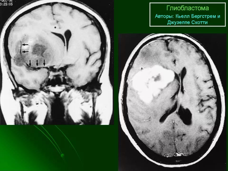 Глиобластома сколько живут. Глиобластома головного мозга на кт. ПЭТ-кт глиобластома. Мультифокальная глиобластома кт. Глиобластома головного на кт.