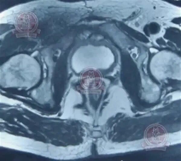 Мрт после простатэктомии. Лимфоцеле малого таза мрт. Лимфоцеле после операции кт.